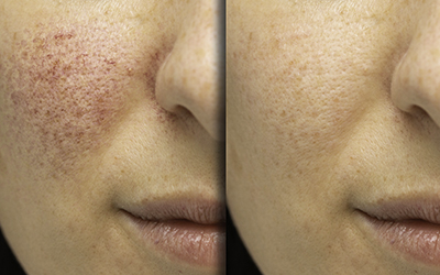 Acne Treatment in Henderson, NV.